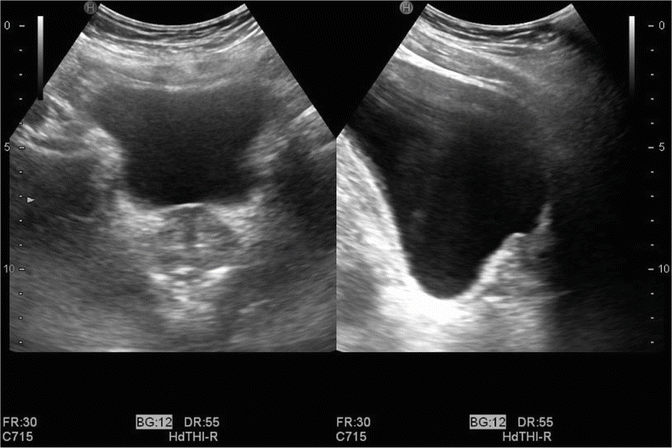 prostate calcification ultrasound images)