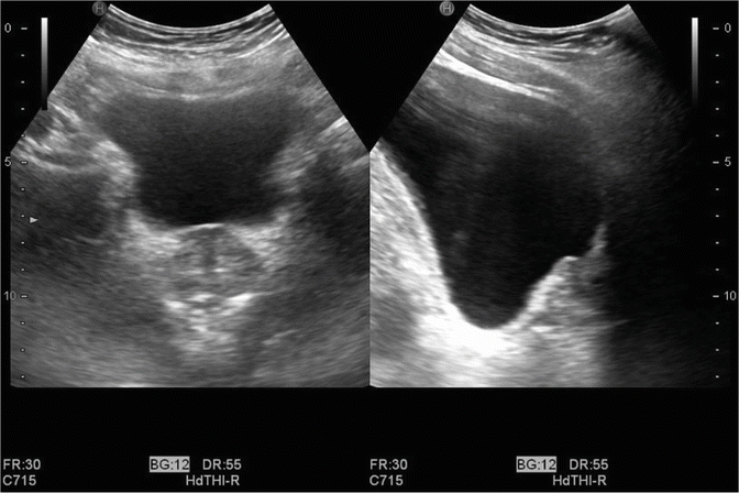 Neuroendocrine cancer of prostate