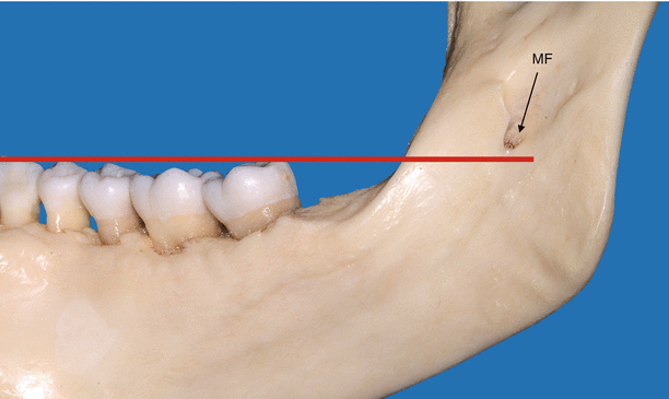 Mandibular Foramen Springerlink