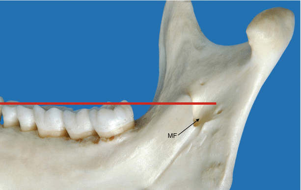 Mandibular Foramen Springerlink