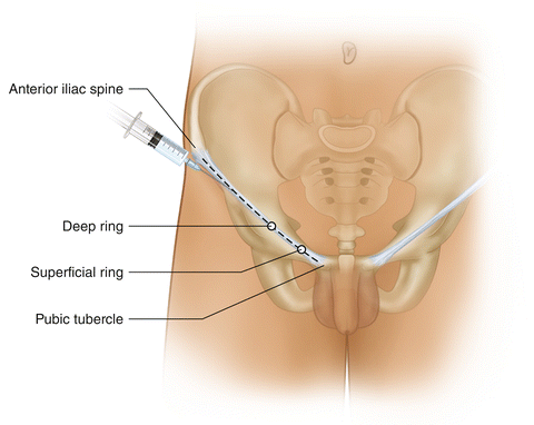 Laparoscopic Inguinal Hernia Repair Surgery Hernia Repair