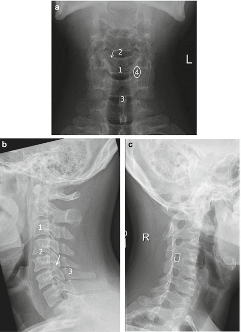 Cervical Spine Imaging: Normal Anatomy and Degenerative Disease