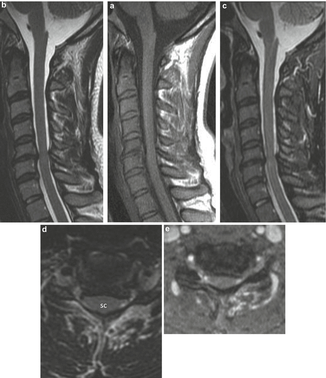 Cervical Spine Imaging: Normal Anatomy and Degenerative Disease