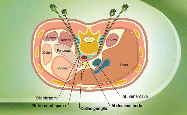 Celiac Plexus Block Springerlink