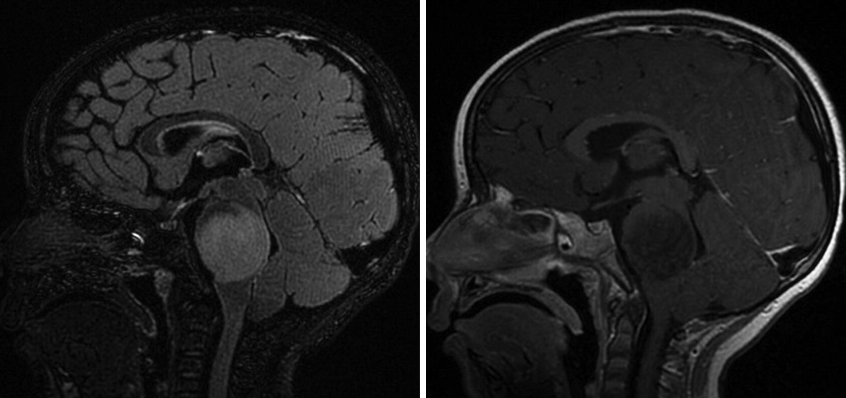 High Grade Glioma Including Diffuse Intrinsic Pontine Diffuse Intrinsic Pontine Glioma