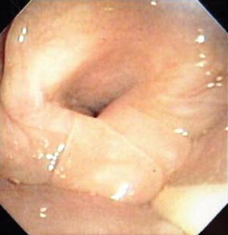 Management Of Myxedema Coma Springerlink Management Of Myxedema Coma Springerlink