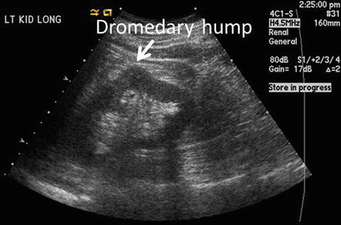 Renal Ultrasound Springerlink