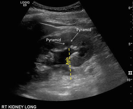 Renal Ultrasound Springerlink - 