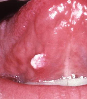 Papillary Lesions Springerlink