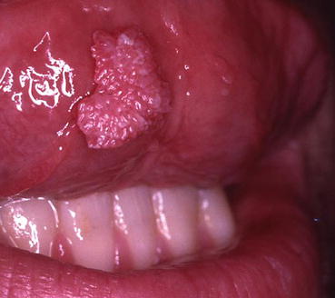 papillary lesion mouth