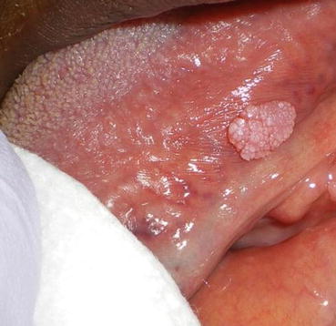 papillary lesion under tongue