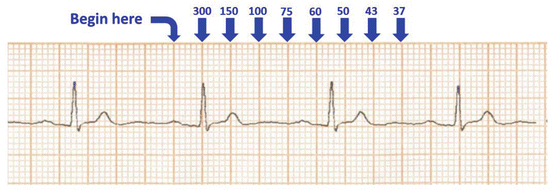 Electrocardiography Basic Knowledge With Focus On Fetal And Pediatric Ecg Springerlink