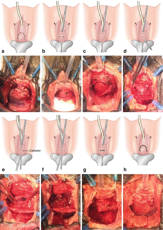 Female Urethral Diverticulum Springerlink