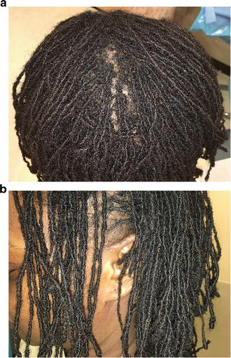 Ethnic Hairstyling Practices And Hair Prostheses I Dreadlocks