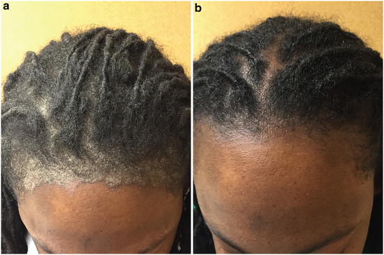 Seborrheic Dermatitis Springerlink
