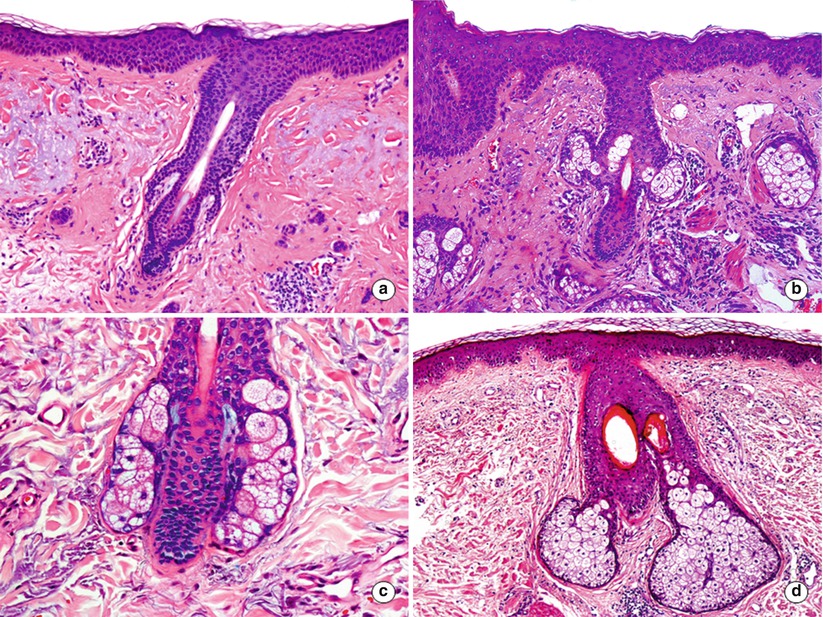 Embryology Anatomy Histology And Physiology Of The Sebaceous Glands Springerlink