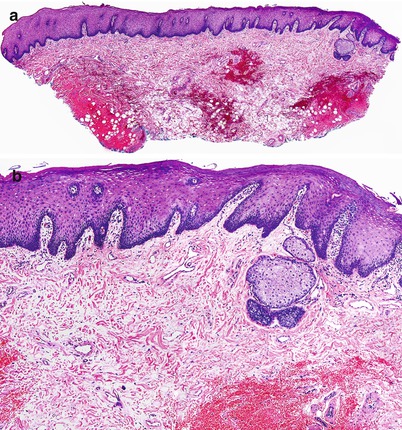 Ectopic Sebaceous Glands: Fordyce’s Spots, Tyson’s Glands, and