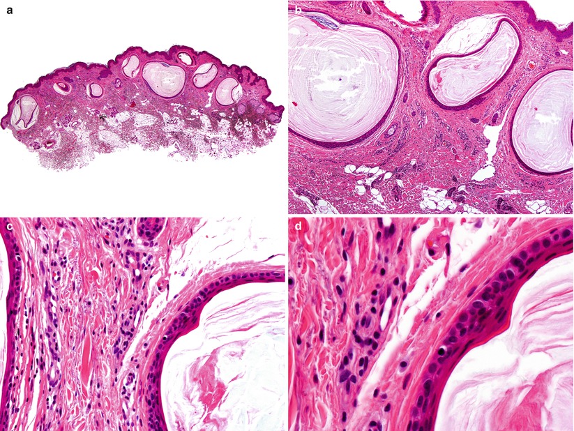 Steatocystoma Springerlink
