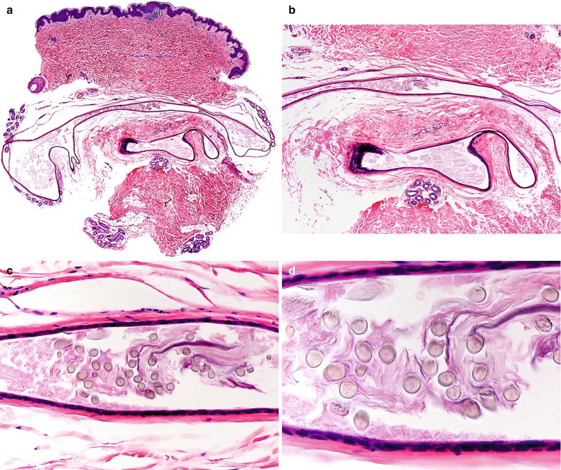 Steatocystoma Springerlink