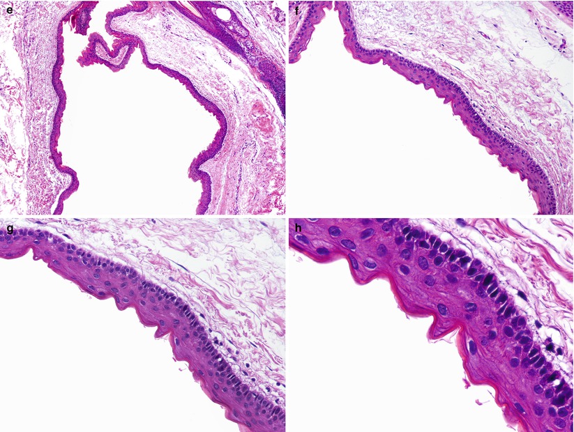 Steatocystoma Springerlink