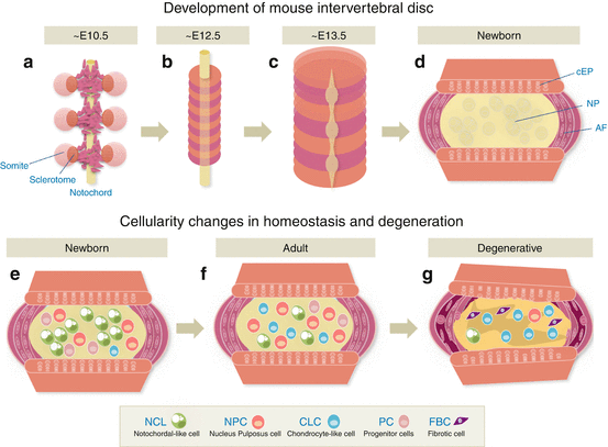 Intervertebral Disc Degeneration Springerlink