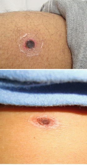 Scrub Typhus And Its Causative Agent Orientia Tsutsugamushi Springerlink