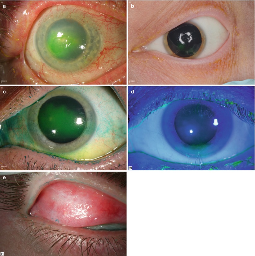 Clinical Presentation of Mucosal Acute and Chronic Graft 