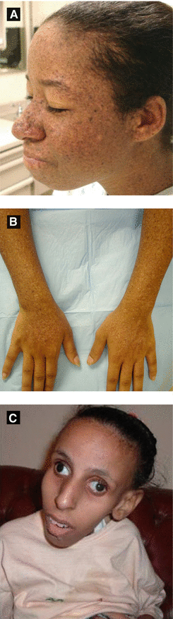 Pediatric Dermatology Springerlink Pediatric Dermatology Springerlink