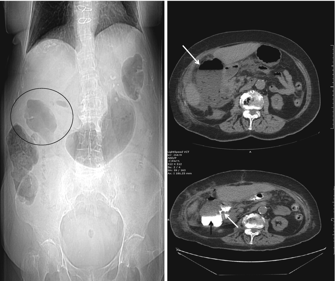 Complicated Peptic Ulcer Findings On Abdominal Ct Scan Springerlink