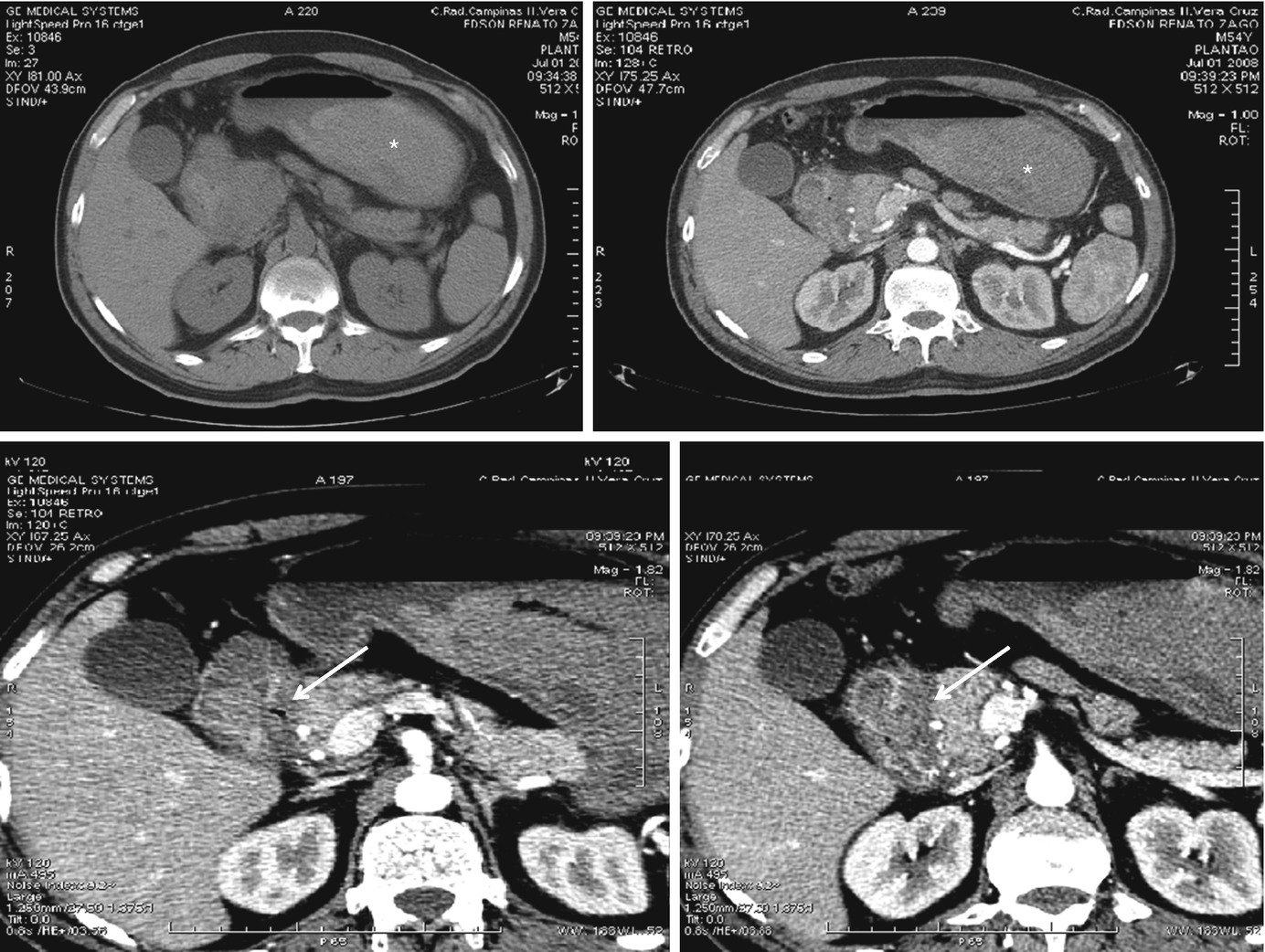 photo What Does An Ulcer Look Like On A Ct Scan abdominal ct scan