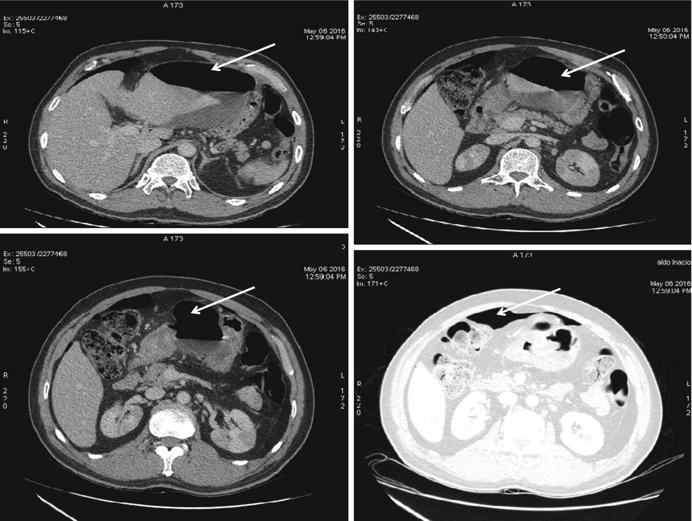 picture What Does An Ulcer Look Like On A Ct Scan abdominal ct scan