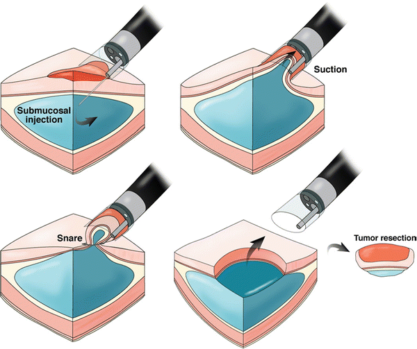Endoscopic Mucosal Resection Emr Springerlink
