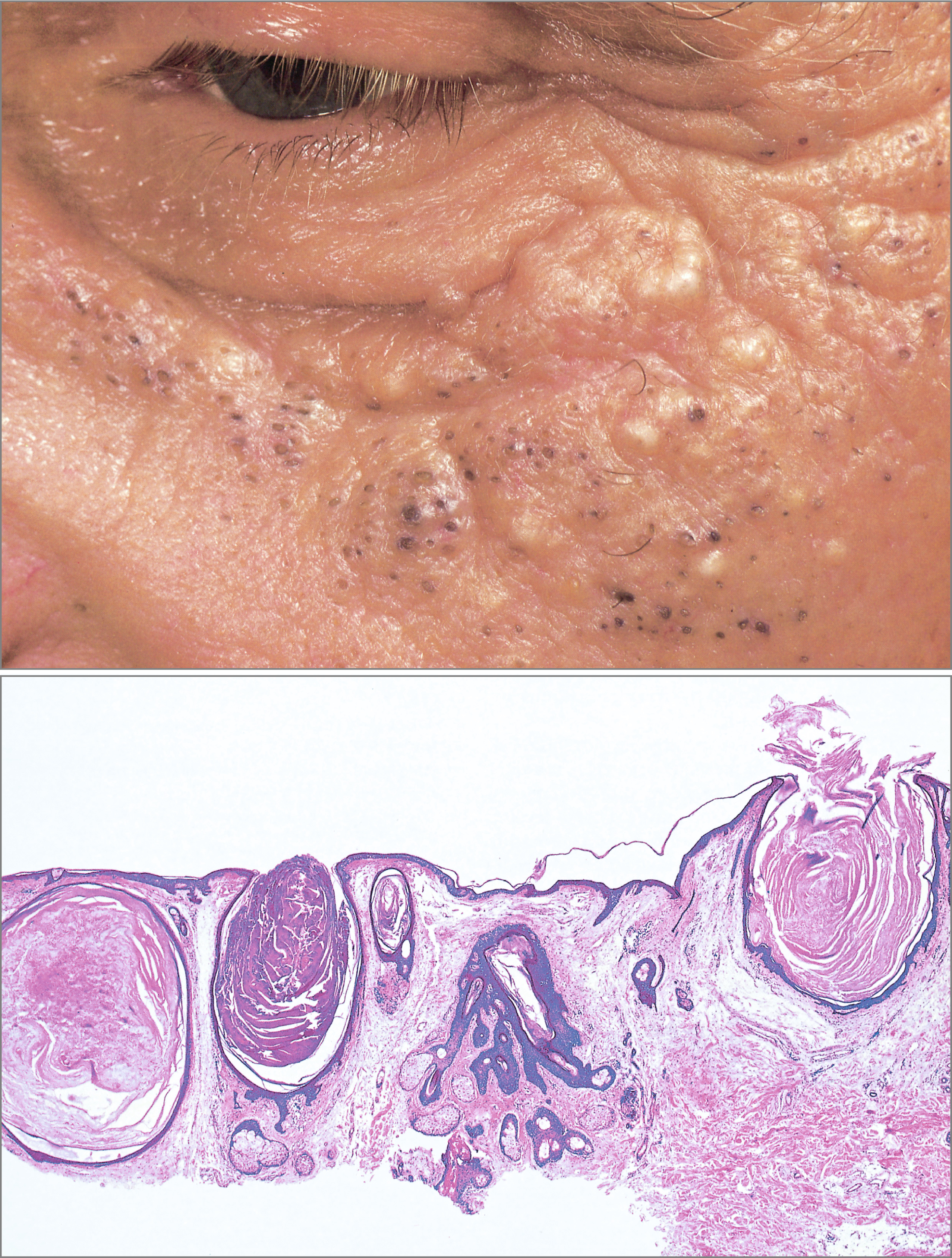 Acne Mimicking Diseases Springerlink