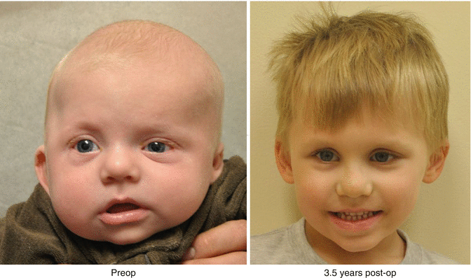 plagiocephaly older child