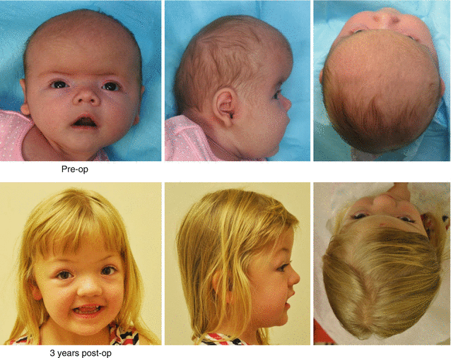plagiocephaly 3 year old