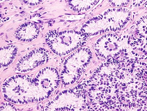 Differential Diagnosis Of Sertoli Cell Nodules Springerlink
