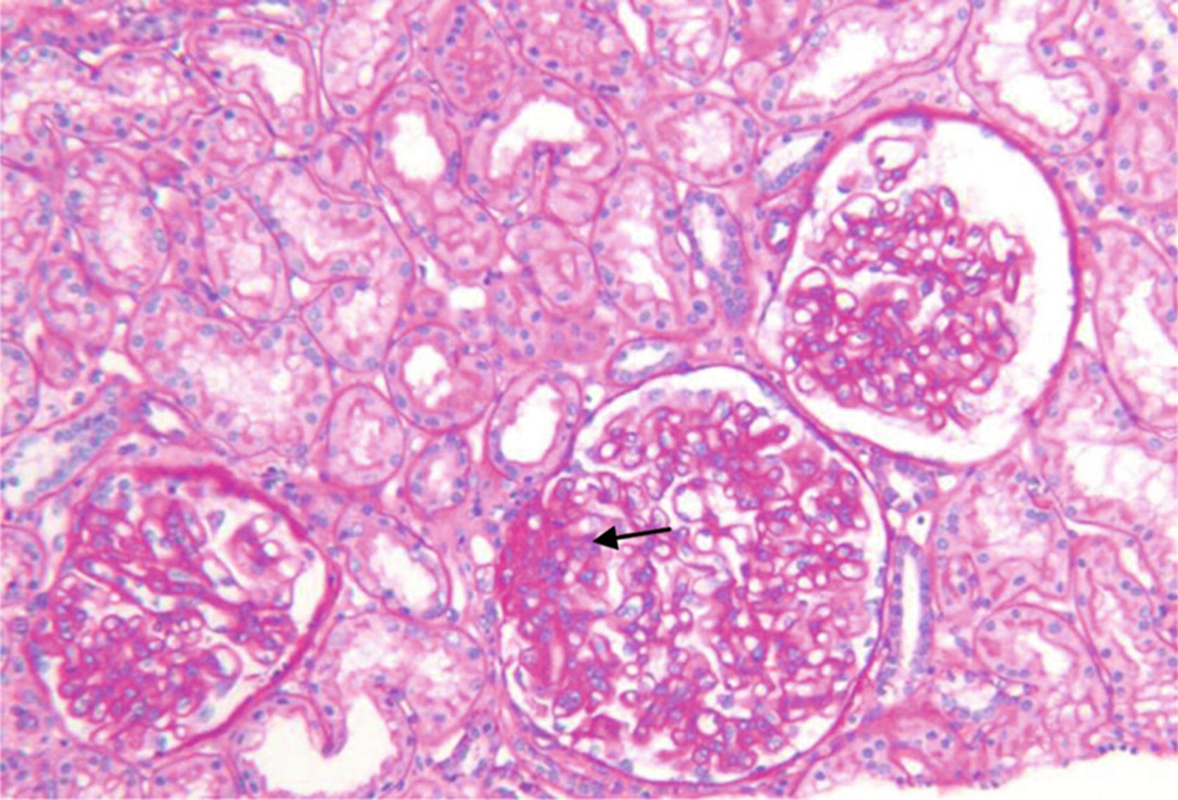 fokal segmentell glomeruloskleros