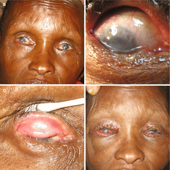 What causes malaria on the lips How to treat this insidious virus What causes malaria on the lips How to treat this insidious virus
