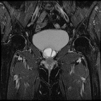 Periurethral Bulking Agent Injection in the Treatment of Female Stress ...