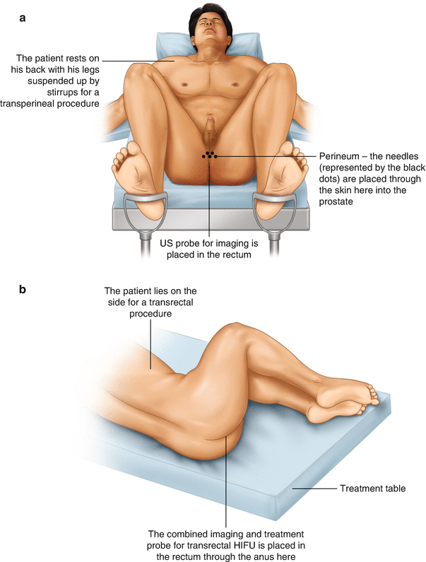 Focal Therapy for Prostate Cancer: A Guide for Patients | SpringerLink