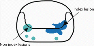 Identifying And Characterizing The Index Lesion Springerlink