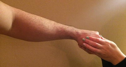 Medial Epicondylitis Springerlink