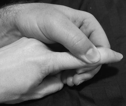 Mallet Finger And Jersey Finger Springerlink
