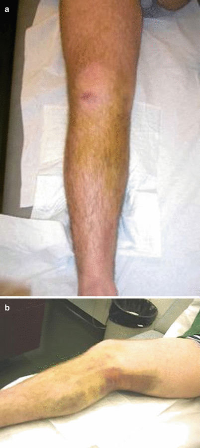 Knee Instability And Dislocations Springerlink