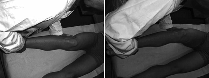 Knee Instability And Dislocations Springerlink