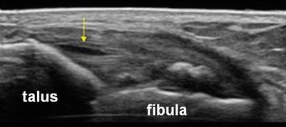 Ankle Sprain Springerlink
