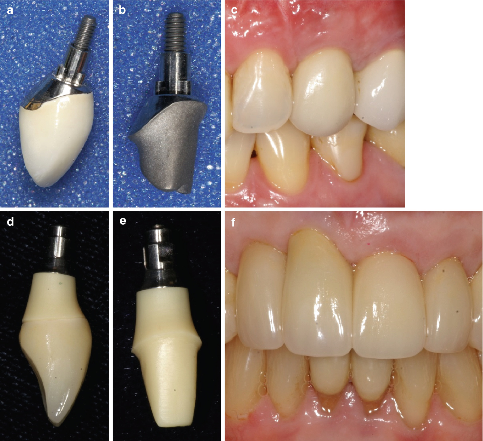 Digital Implant Abutment And Crowns In The Aesthetic Zone Springerlink