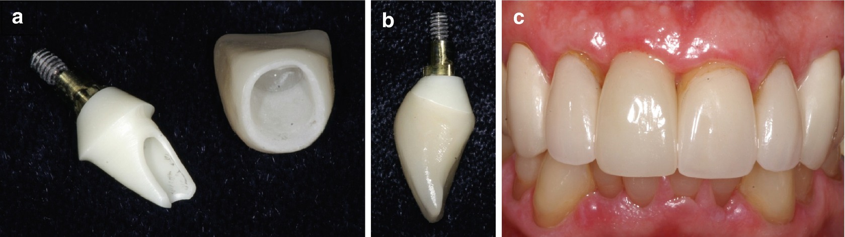 Digital Implant Abutment And Crowns In The Aesthetic Zone Springerlink