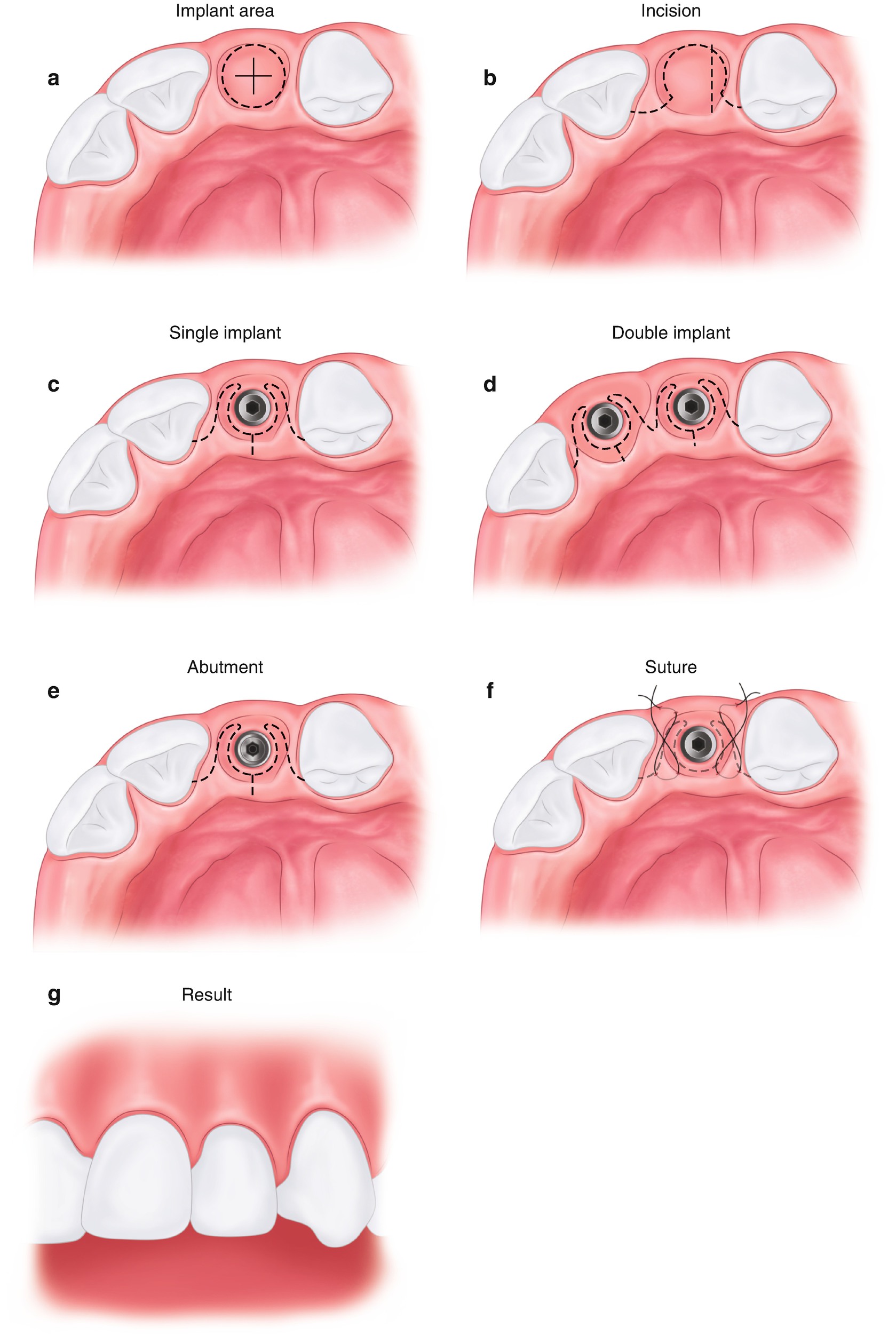 Flap Design, Suturing, and Healing SpringerLink