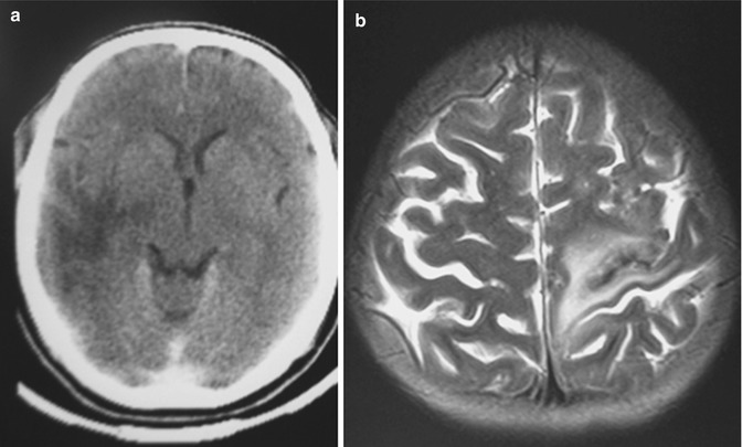 Featured image of post Cerebritis Radiology Ct A ct radiology scan allows the radiologist to see the location nature and extent of many different diseases or abnormalities inside your body